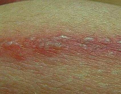 带状疱疹症状有哪些？如何防治此种皮肤病？