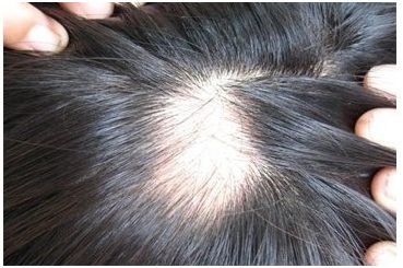     福州斑秃形成的主要因素有哪些？